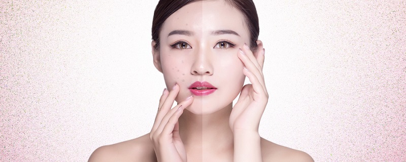 日本狮王祛痘膏怎么样 狮王祛痘膏对痘印有效吗