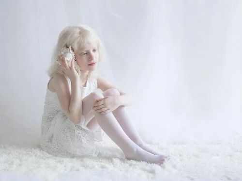 白化病是什么遗传病?白化病是什么病-第1张图片-