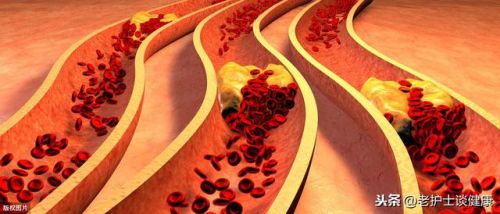 高血脂的治疗方法_高血脂的治疗原则-第1张图片-